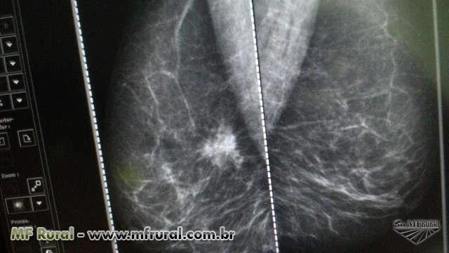 Radiologia - Venda de Mamógrafo Barato