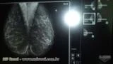 Radiologia - Venda de Mamógrafo Barato