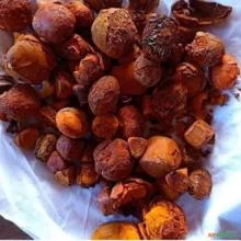 Gallstones